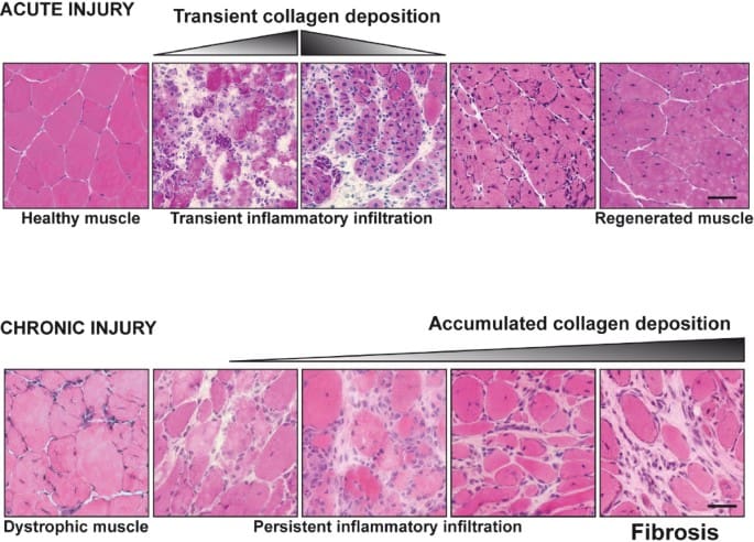 collagen and fibrosis