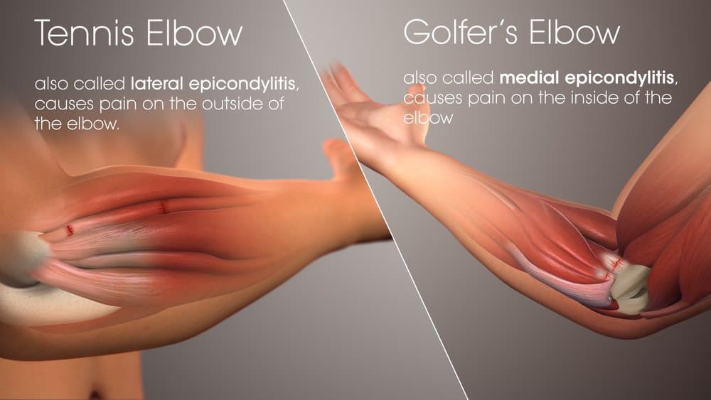 Golfers elbow and tennis elbow are common injuries affecting different elbow tendons.